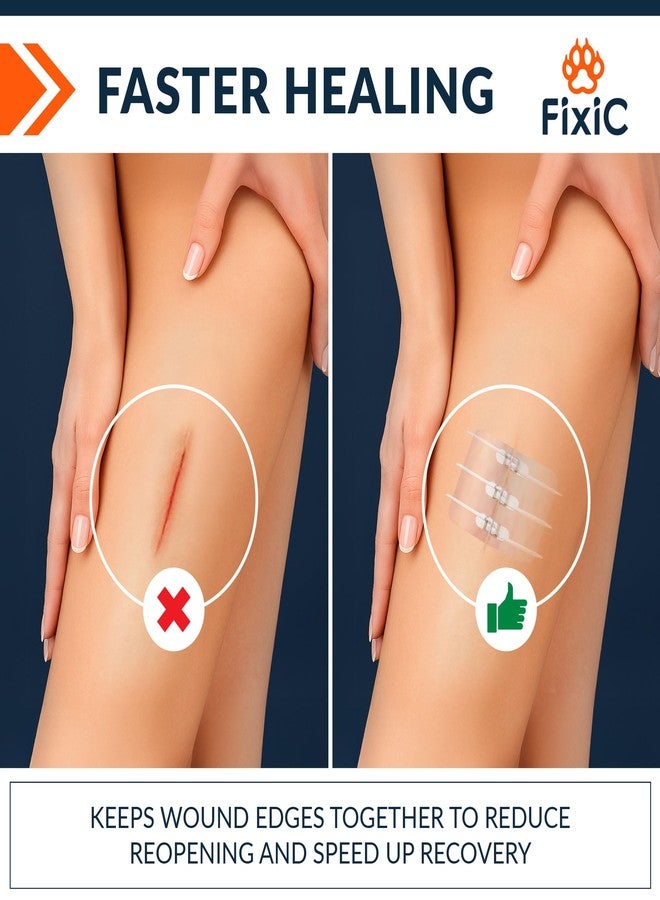 Fixic Butterfly Bandages - 2-Types Zip Wound Closure Strips - Ideal Wound Closure Kit - Sutures Free Butterfly Stitches Bandage - Stitches Kit with 4 Bandages, 4 Pads, and 4 Wipes Included! - Image 3